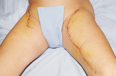 Vernähte Inzision zur Entnahme