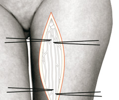 Entnahme von Lymphgefäßen