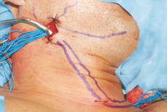 Das Transplantat wird eingebracht