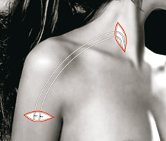 Transplantierte Gefäße am Arm