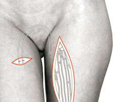 Transplantierte Gefäße am Bein